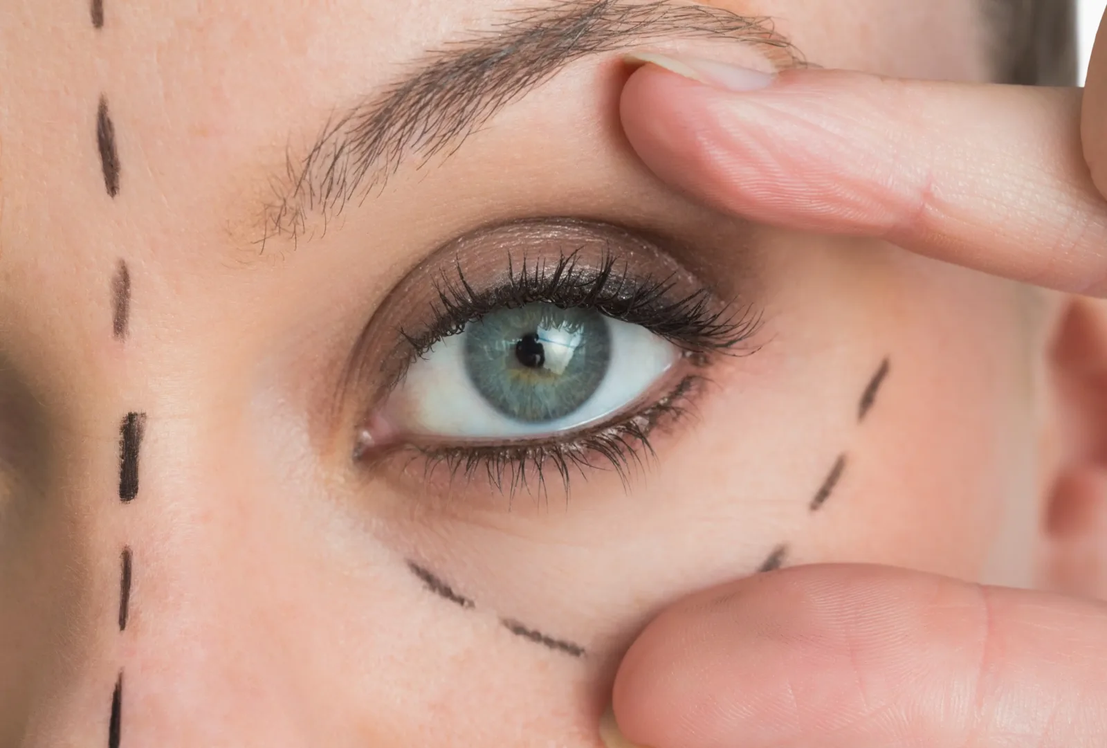 Blepharoplasty in Turkey